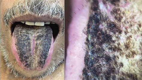 Hairy Black Tongue Pictures