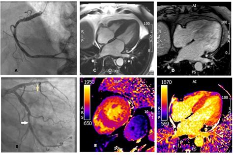 Transient ischemic dilatation in cardiac amyloidosis - Journal of Nuclear Cardiology