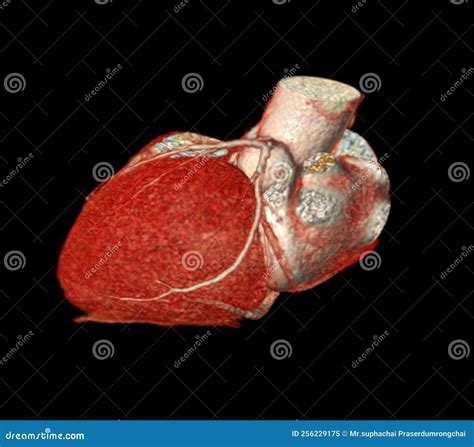 CT Cardiac 3D or CTA Coronary Artery Stock Illustration - Illustration of tomography, patient ...