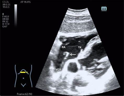 Feasibility Analysis of Ultrasound-Guided Placement of Tunneled ...