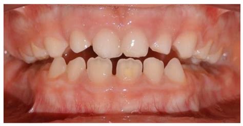 Early Treatment of Anterior Crossbite with Eruption Guidance Appliance ...