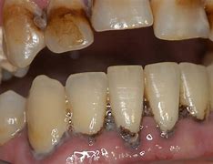 Image result for parodontitis