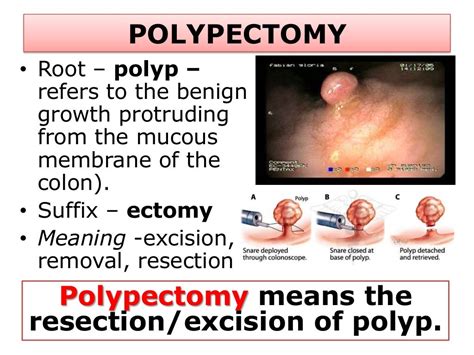 Image result for Colonoscopy Polypectomy