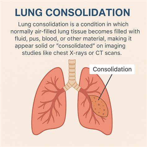 Consolidation Of Lung