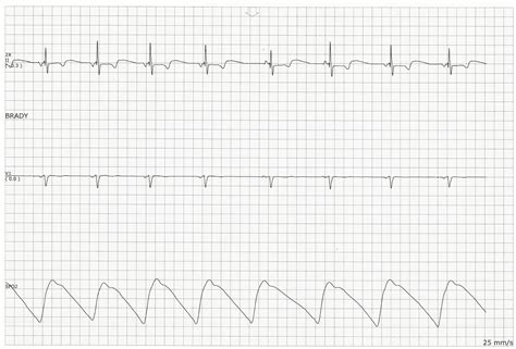 Practice EKG Strips