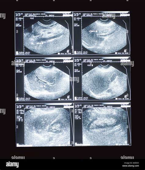 Abdominal Ultrasound Scan Stock Photo - Alamy