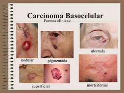 carcinomas 的图像结果