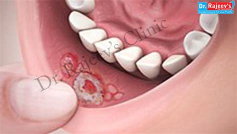 homeopathic treatment for Stomatitis in homeopathy, Stomatitis ...