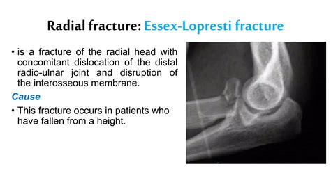 Upper and Lower Extremity fractures | PPTX