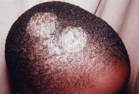 Image result for Hair Splinter Infection