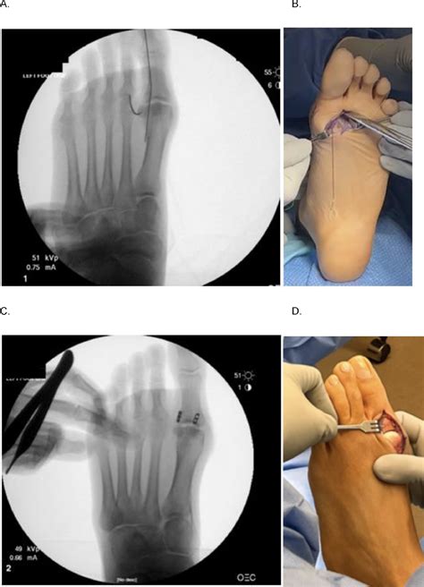 Two incision technique with suture button fixation for the surgical management of turf toe: A ...