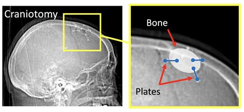 Titanium Plates And Screws Craniotomy at Cristina Lee blog