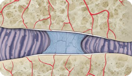 Image result for Via Disc Procedure