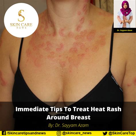 Rashes In The Breast