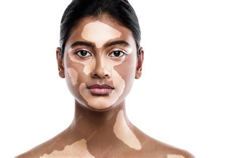 Premium Photo | Beautiful South Asian woman with vitiligo skin disorder against white background