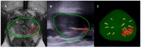 Learning Curve of Transperineal MRI/US Fusion Prostate Biopsy: 4-Year ...