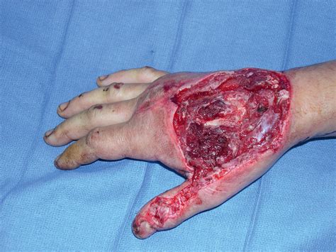Dorsal Hand Reconstruction - Clinical Tree