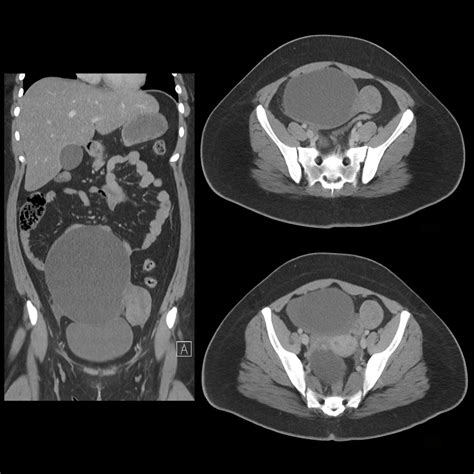 Pediatric Ovarian Cyst | Pediatric Radiology Reference Article | Pediatric Imaging | @pedsimaging
