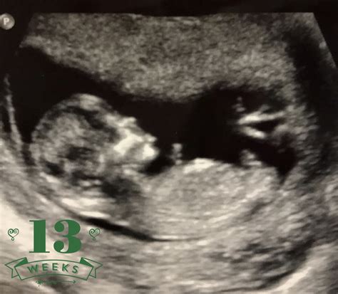 13 Week Ultrasound Pictures