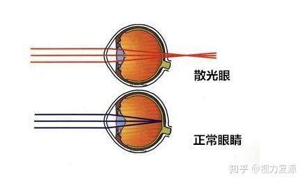 用激光笔照射他人眼睛怎么处理？ - 知乎