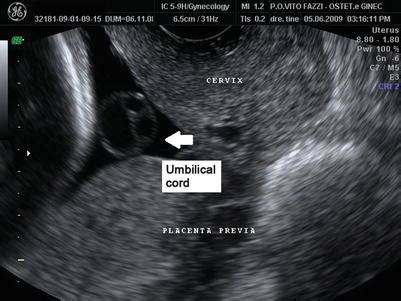 Bildergebnis für umbilical cord abnormalities ultrasound