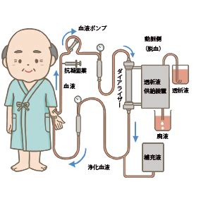 血液濾過透析（HDF）🎨【フリー素材】｜看護roo![カンゴルー]