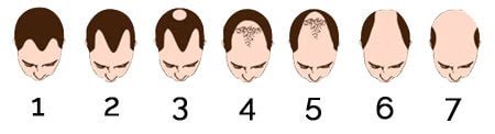 Hair Transplant Surgery - FUE & FUT Hair Transplant in India
