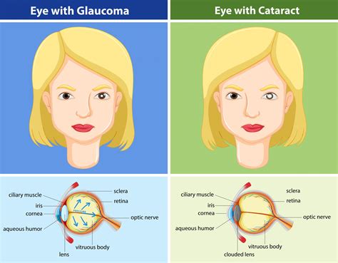 Glaucoma vs. Cataracts: What’s the Difference? - Responsum Health