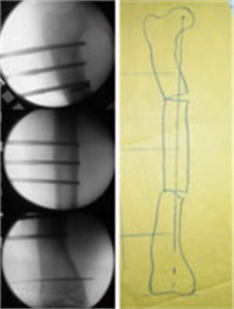 Oblique Plane Deformity