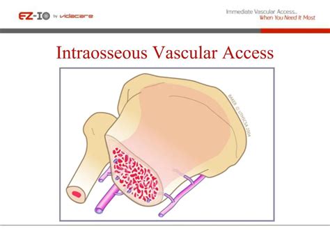 Image result for Intraosseous Access Procedure