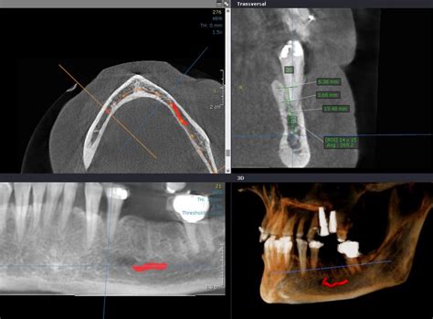 Image result for Tooth Extraction Timeline