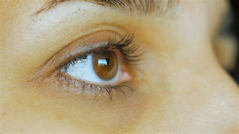 Yellowing Under The Eyes - Infoupdate.org