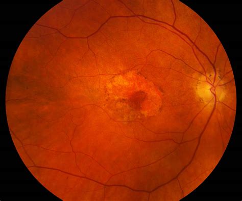 Image result for Macular Degeneration Example