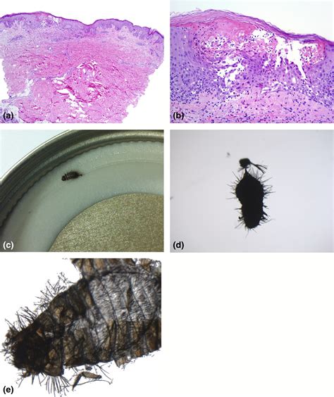 Carpet Beetle Dermatitis A Possibly Under Recognized Entity Macarthur ...