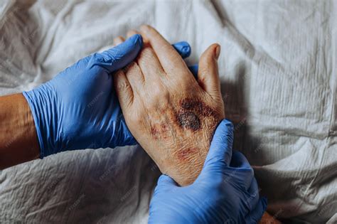Premium Photo | A bruise on the hand of an elderly person known as senile purpura caused by the ...