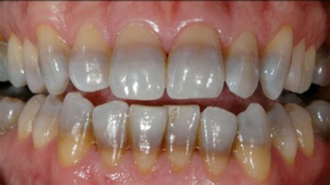 Image result for Tooth Stain