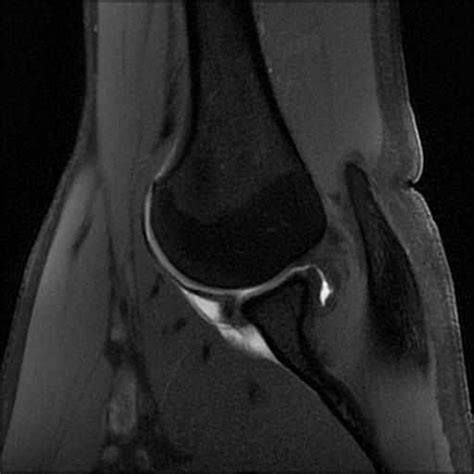 Mr Arthrogram Shoulder 的图像结果