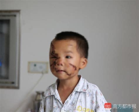 痛心！中山4岁半男童被邻家狗咬伤，脸部缝合数十针，几乎毁容