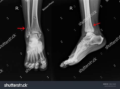 251 Metatarsal Fracture Treatment Images, Stock Photos & Vectors | Shutterstock