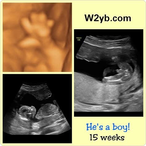 15 Weeks Pregnant Ultrasound 2024