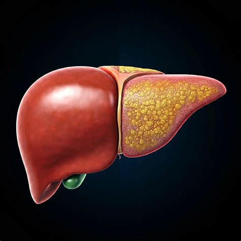 Hígado Graso | Tratamiento | Dr. Roberto Campos Arce