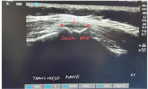 Comparison of ultrasound-guided versus conventional technique for ...