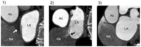 Diagnostic Performance of Cardiac Computed Tomography for Detecting ...