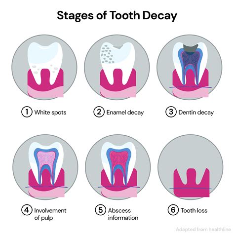 Tooth Cavity Stages