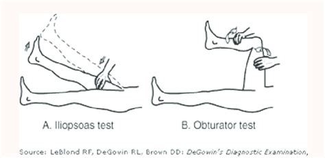 Image result for Psoas Sign