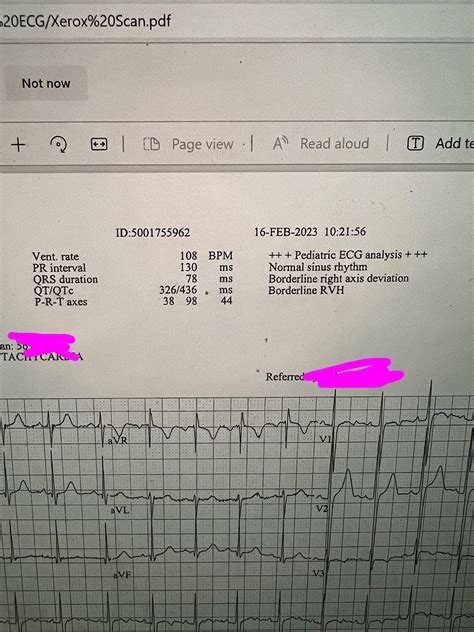 What Does Borderline ECG Mean On An EKG?