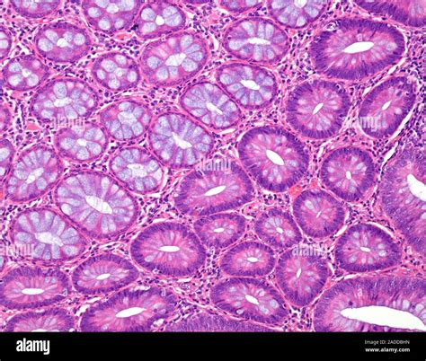 Tubular colon polyp, light micrograph. This specimen shows tissue from a tubular adenoma ...