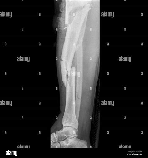 Broken Leg Bones