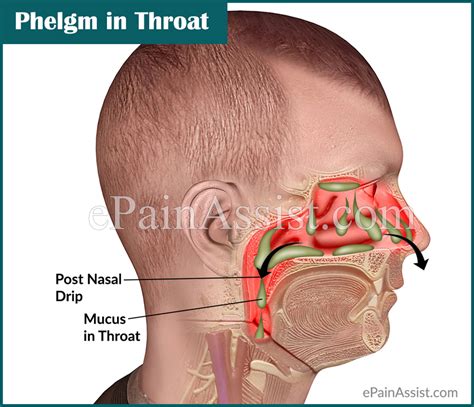 Phlegm in Throat or Mucus in Throat: Causes & Ways to Get Rid of it!