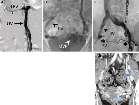 Venous Anatomy and Collateral Pathways of the Pelvis: An Angiographic ...